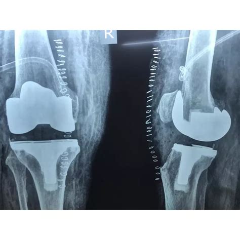 Single Sitting Total Hip And Knee Replacement F/75 Obese - Dr Samir ...