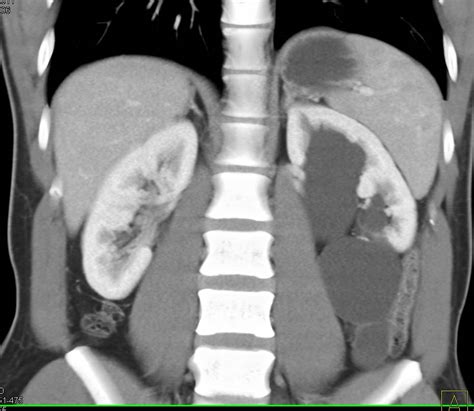 Kuvatulokset haulle parapelvic cyst kidney