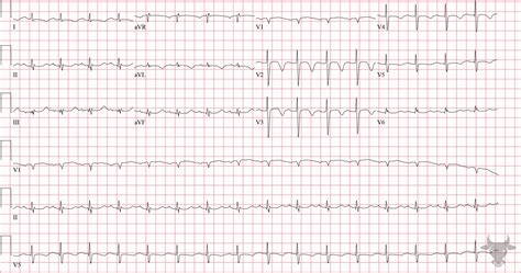 Cerebral T waves | ECG Stampede