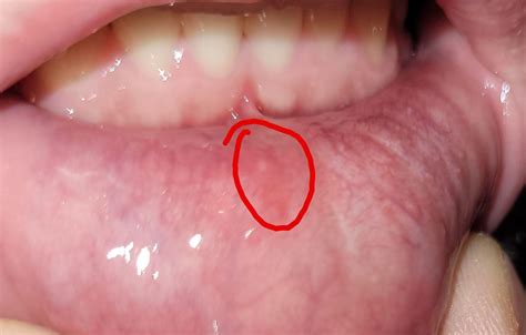 Bump On Lower Inside Lip