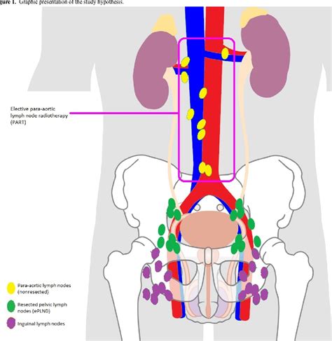 Lymph Nodes Para Aortic