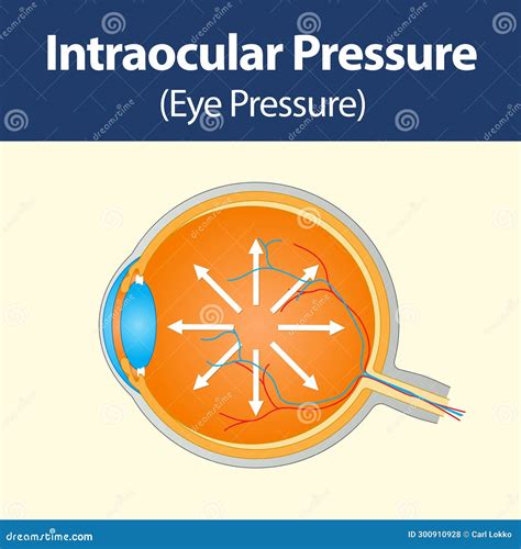 Intraocular Pressure High Level at Pauline Dane blog