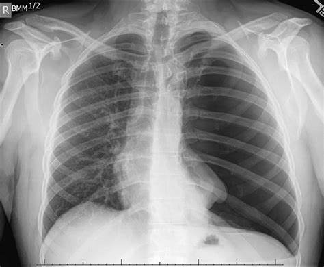 Mild Pneumothorax X Ray