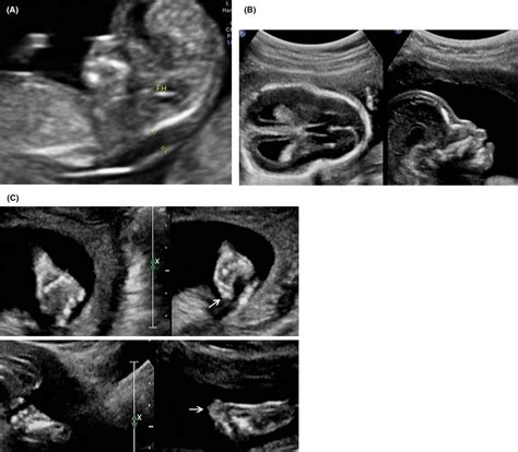 Prenatal diagnosis of Pfeiffer syndrome type 2 with increased nuchal translucency - Hu - 2021 ...