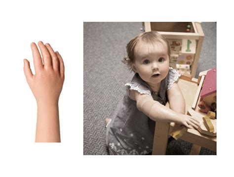 Best Myoelectric Pediatric Prosthesis Solutions | KARE