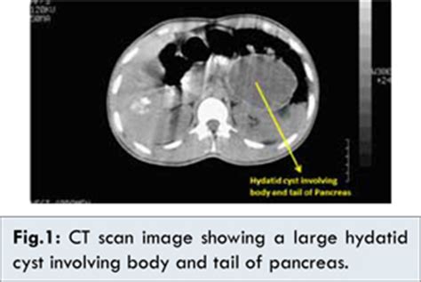 Pancreatic Hydatid Cyst Managed Successfully by Internal Drainage