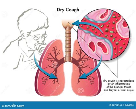 Dry Cough Stock Image - Image: 28712961