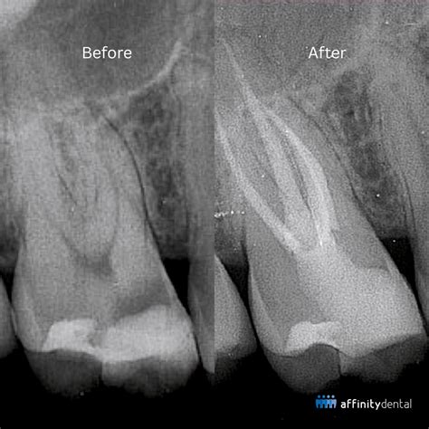 Root Canal Myths vs Facts | Affinity Dental Clinics