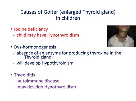 Hypothyroidism in children 2021 | PDF