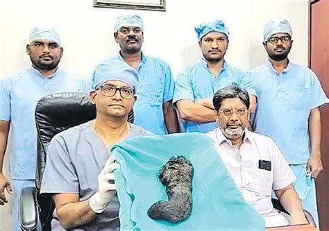 'Trichobezoar': How doctors removed one-kilo hair from 14YO girl's ...