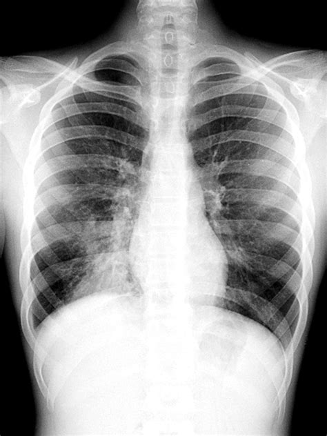 How To Diagnose Pneumonia X Ray at Erica Laforge blog