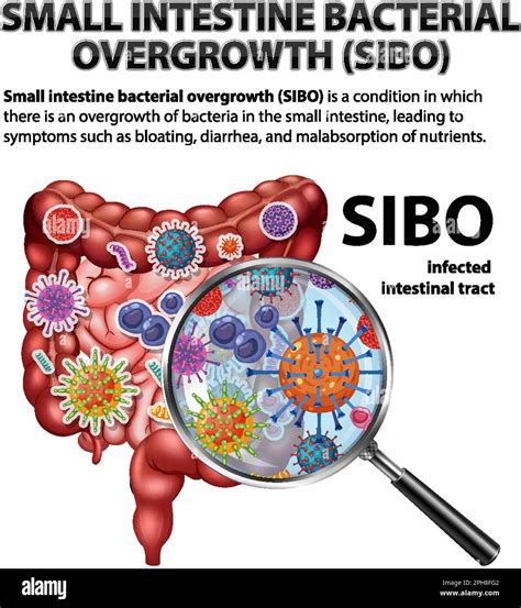 Small Intestine Bacterial Overgrowth (SIBO) illustration Stock Vector Image & Art - Alamy