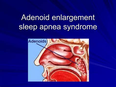 Adenoid enlargement.ppt