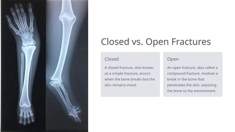 Fracture-Classification and types and differentiation | PPTX