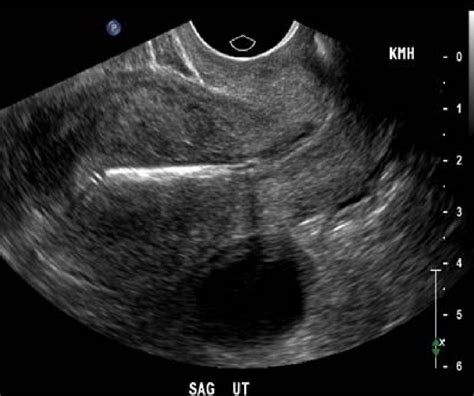 Why gynecologists think IUDs are the best contraceptive - Vox