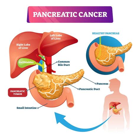Symptoms Of Stage 4 Pancreatic Cancer