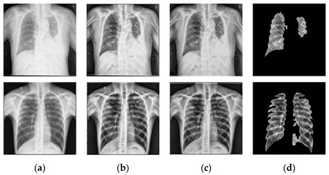 A Novel Machine Learning Approach for Tuberculosis Segmentation and ...