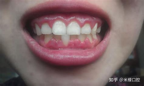 牙医说 | 刷牙经常出血，当心牙周疾病！ - 知乎