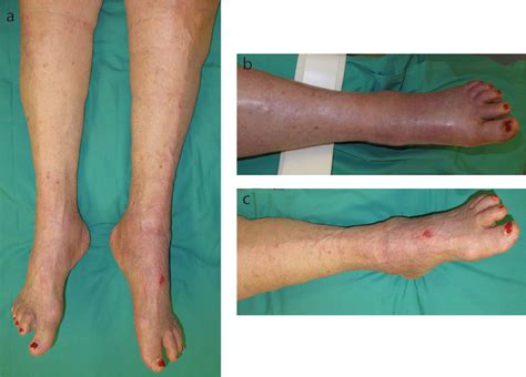 Phlegmasia Cerulea Dolens