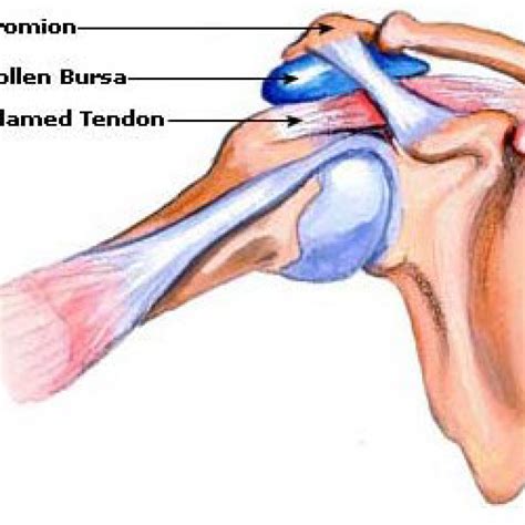 Sudden Shoulder Pain Without Injury: What Are The Causes? – YZPH