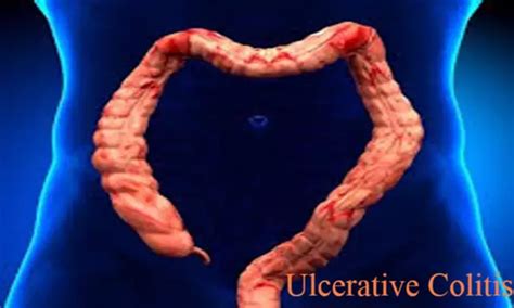 PICaSSO score: a useful endoscopic tool in ulcerative colitis, Finds study