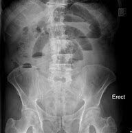 Image result for Bowel Obstruction On X-ray