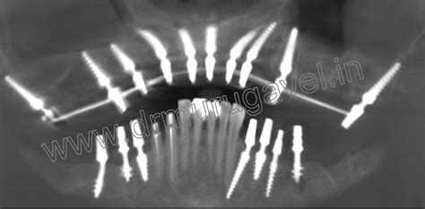 » upper full mouth reconstruction with dental implants in India