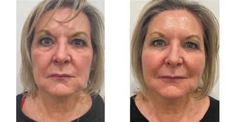 Threading Facelift Before and After 的图像结果