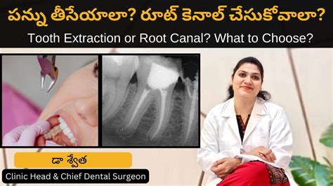 Difficult Tooth Root Extraction 的图像结果