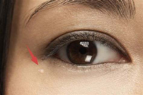 【图】眼睛周围的脂肪粒怎么去除？ 4种方法轻松消除_眼睛周围的脂肪粒怎么去除_伊秀美容网|yxlady.com