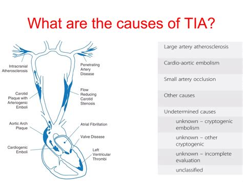 Dont Ignore Transient Ischemic Attack | PPT