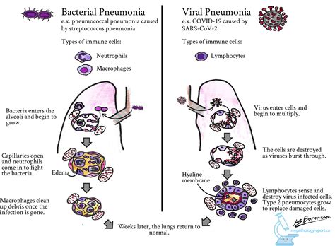 Pneumonia : Pneumonia Is An Infection Of The One Or Both Lungs Mainly Caused By Bacteria ...