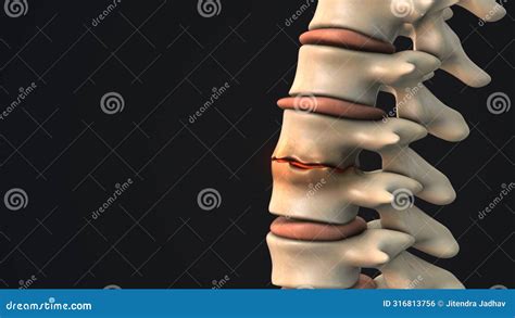 Disc Degeneration with Osteophyte Formation in the Human Spine Stock ...