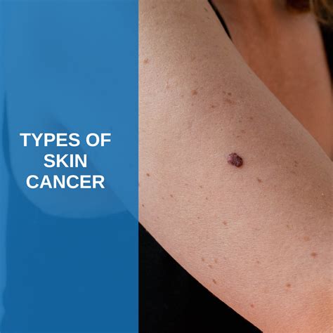 Pre Cancer Skin Spots