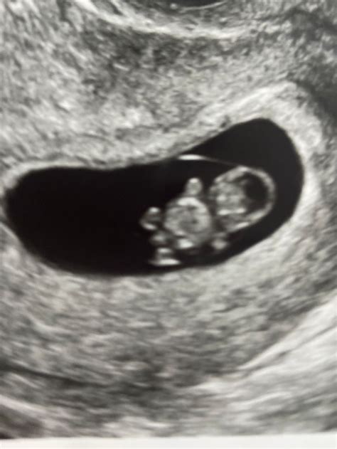 8 Week Ultrasound Heartbeat