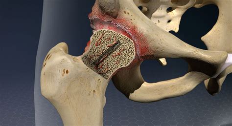 AVN & Stem Cell Surgeon | Dr Ujwal Ramteke