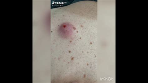 Image result for Extreme Zit Exploding