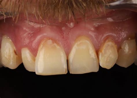 Gum Abscess Popped? Thinking of Popping It Yourself?