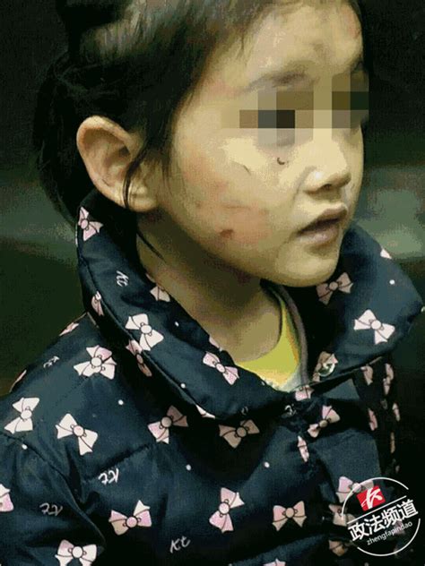 6岁女孩遭生母虐打头发被扯秃 为什么父母会虐待孩子？_荆楚网