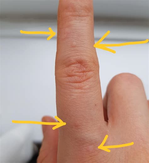 Image result for tea tree oil warts