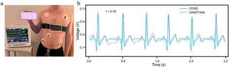 A Chest Strap-Based System for Electrocardiogram Monitoring