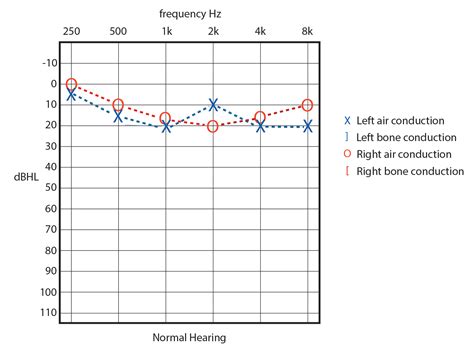 Audiogram Types and examples 的图像结果