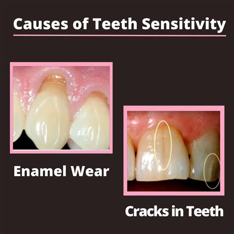 What Causes Teeth Sensitivity To Heat at Tamara Juarez blog