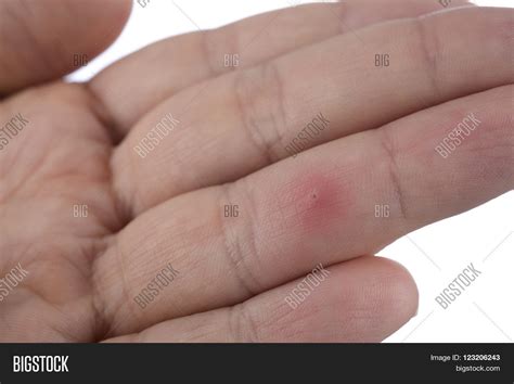 Image result for Splinter in Hand