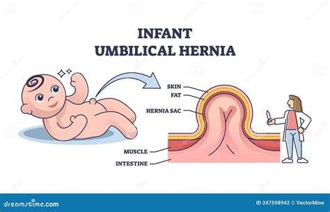 Infant Umbilical Hernia As Painless Lump Near Belly Button Outline Diagram Vector Illustration ...