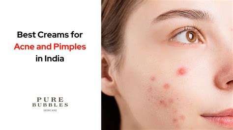 Top 5 Best Creams for Acne and Pimples in India (2026) – Pure Bubbles ...