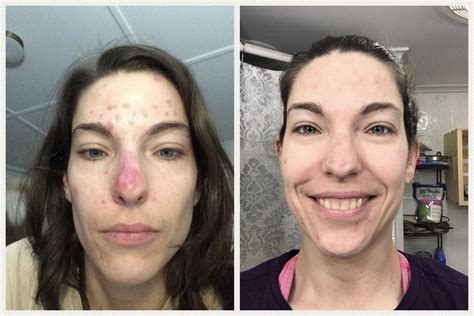 Weight Gain With Lupus at Ron Edelstein blog