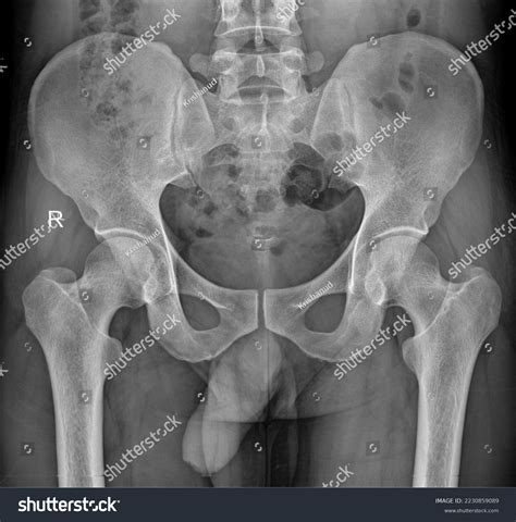 Labeled Pelvis X Ray at Deloris Colvin blog