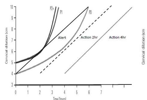 Image result for Partogram Examples
