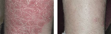 Large Patches - Eczema and Psoriasis Complete Care Bundle – Oleum Cottage